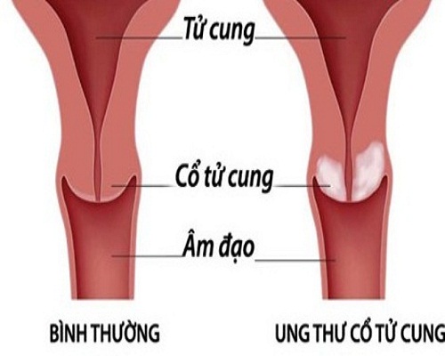 ung thư cổ tử cung