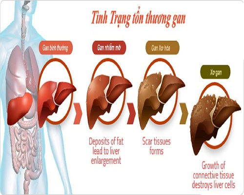 Phát triển của ung thư gan