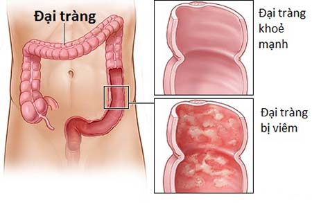 những sai lầm của người ung thư đại tràng